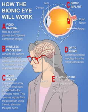 Como funcionar&aacute; o ollo bi&oacute;nico